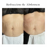 Reductos de Abdomen: 4 Secciones