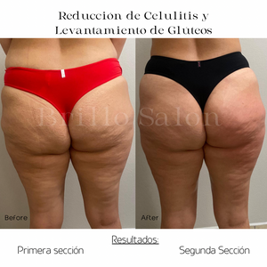 Reducción de Celulitis y Levantamiento de Glúteos